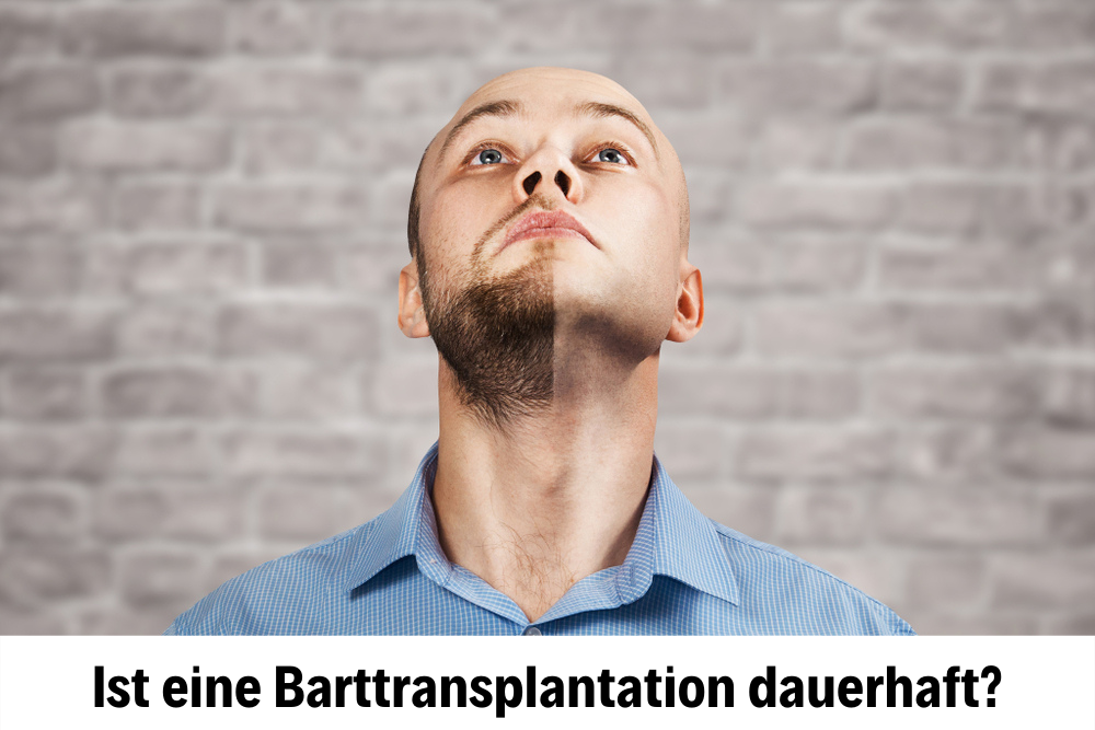 Barttransplantation